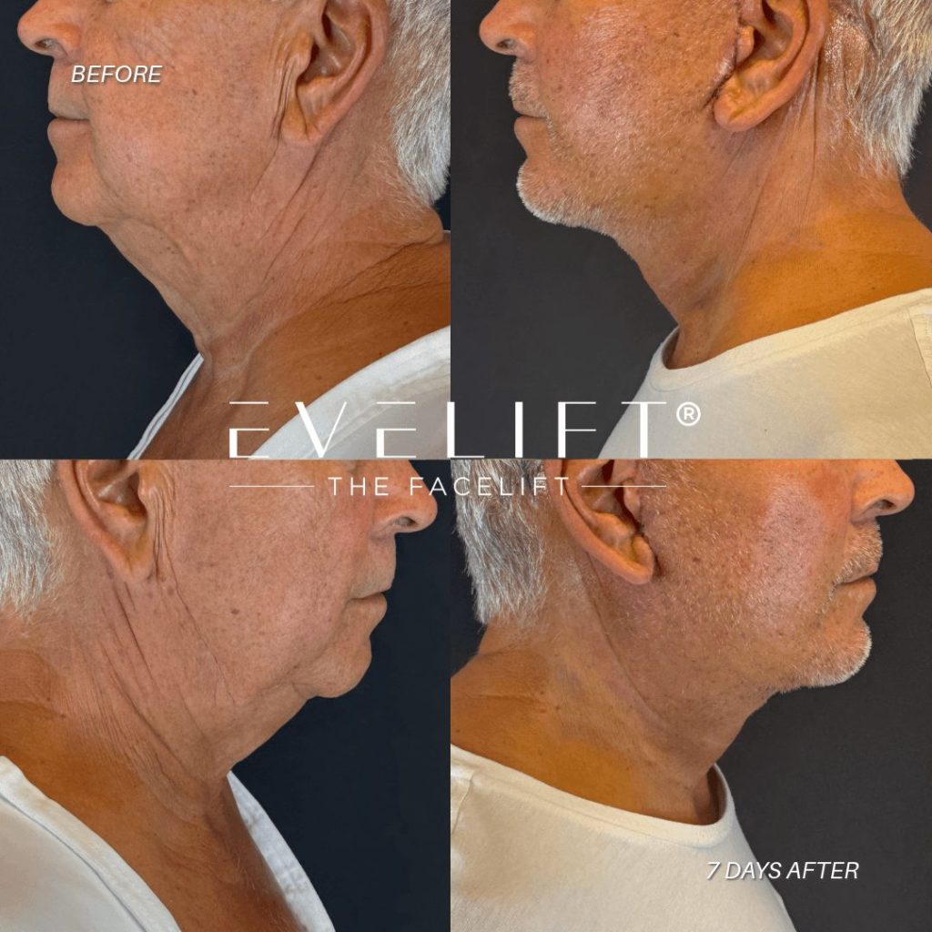 EVELift Results 8