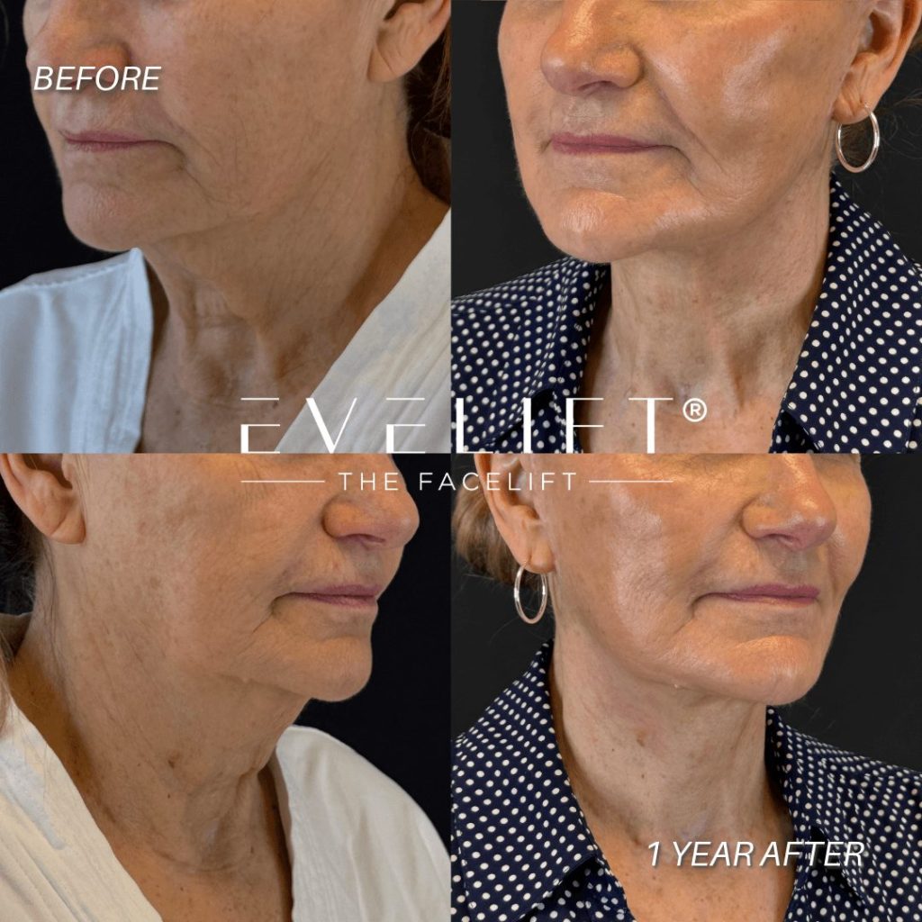 EVELift Results 6