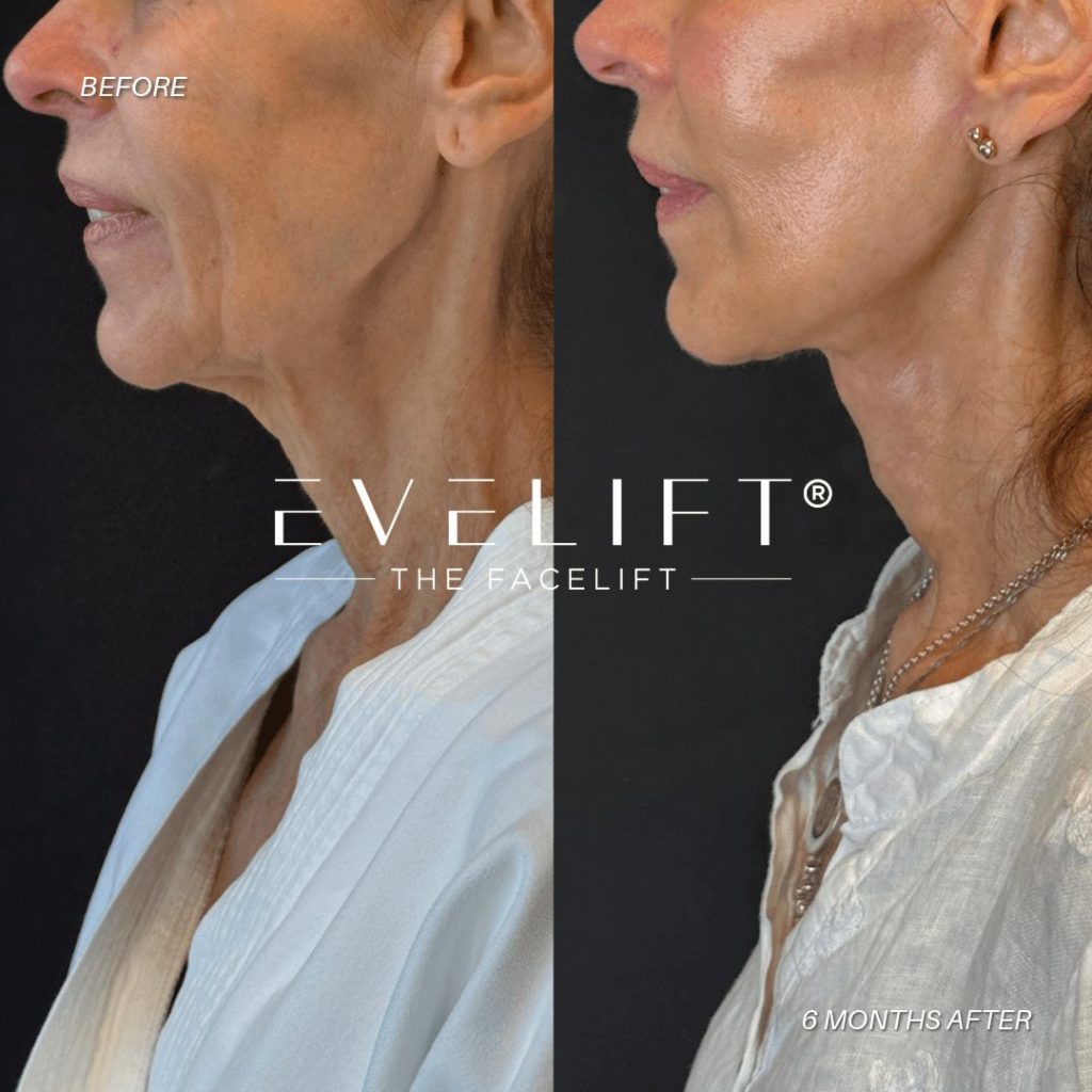 EVELift Results 3
