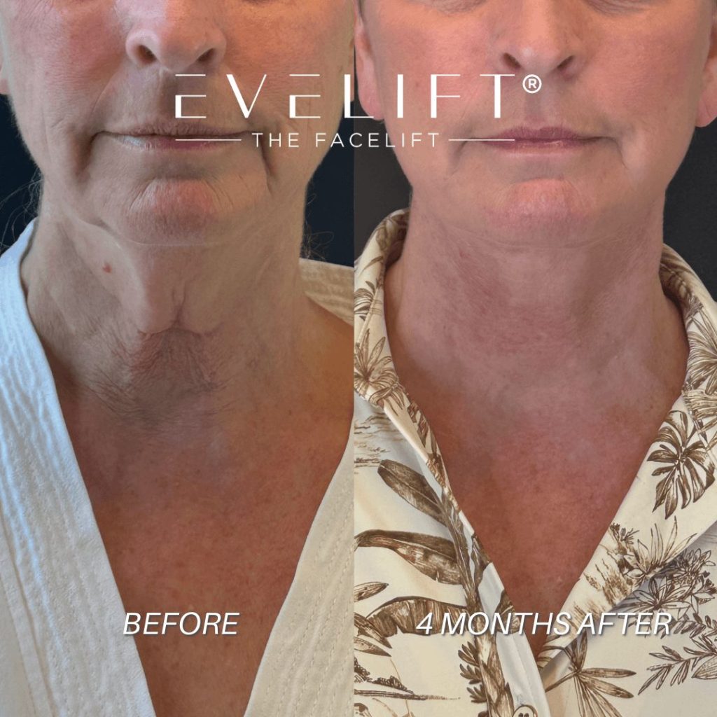 EVELift Results 2